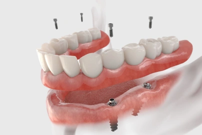 Full-Arch Fixed Implant Restoration