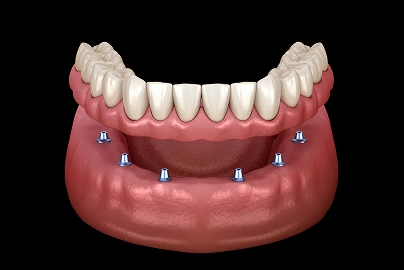 Implant-Supported Dentures