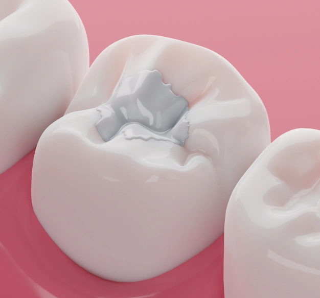 Natural-Looking Cavity Treatment